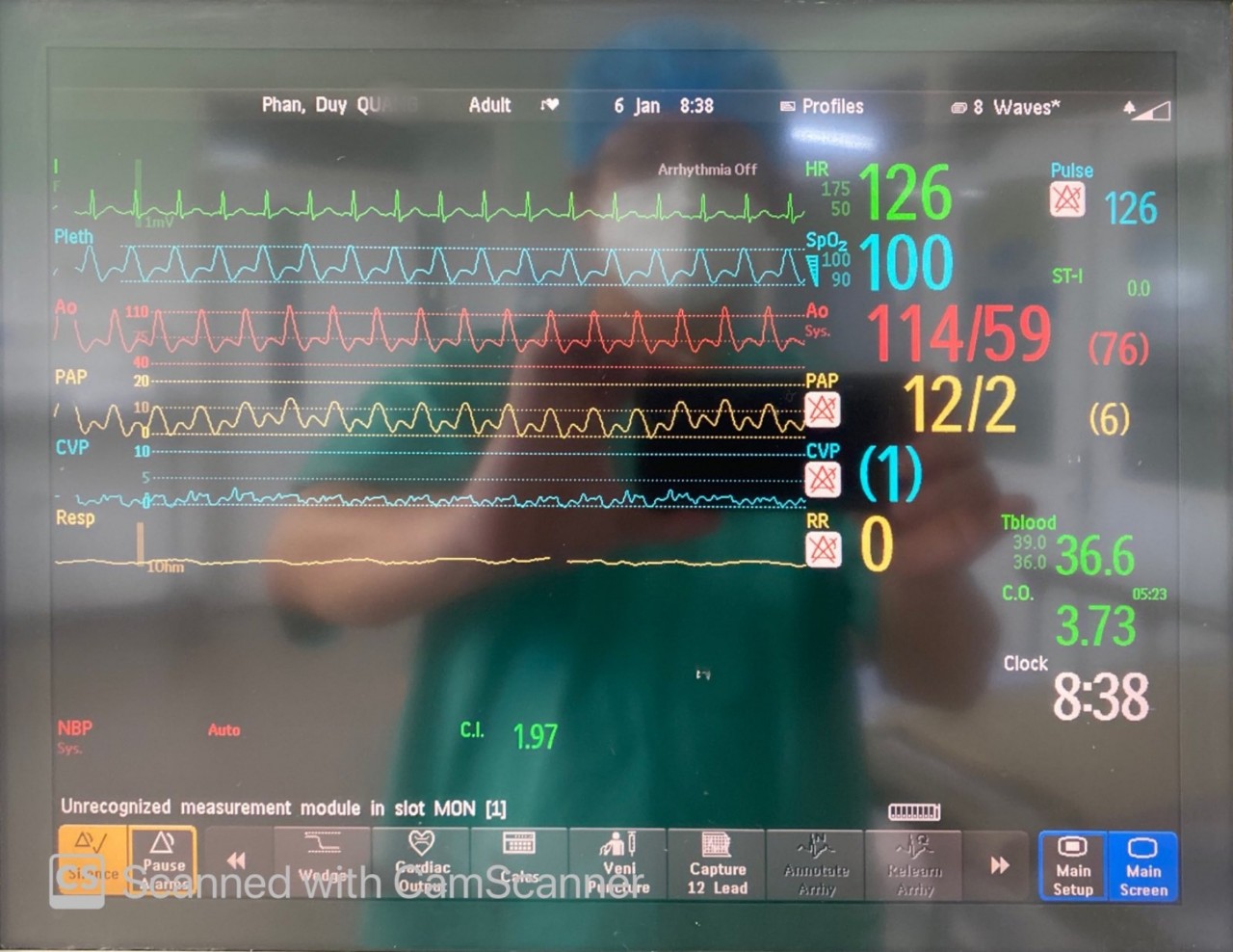 Ca ghép tim thành công đầu năm mới