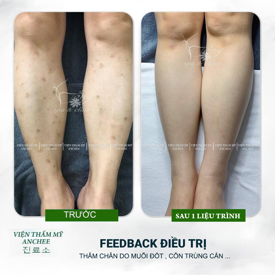 Bống Spa  Clinic - Cách trị sẹo thâm muỗi đốt tốt nhất hiện nay