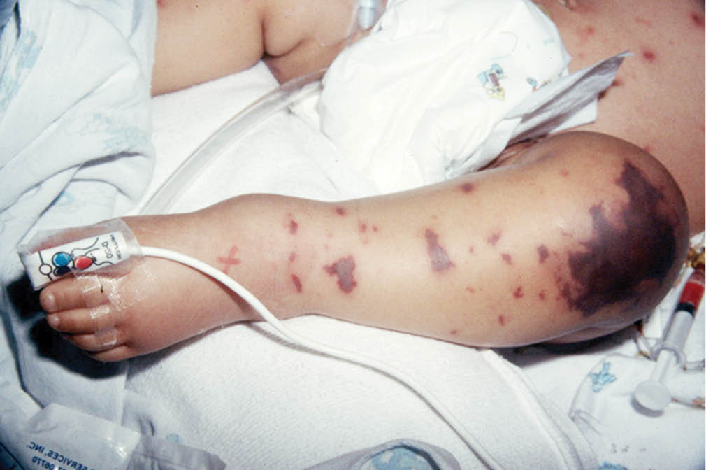 Cảnh báo bệnh nhiễm não mô cầu vào mùa