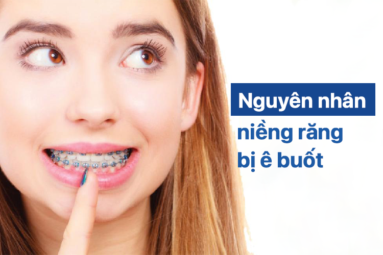 Niềng răng bị ê buốt Nguyên nhân và giải pháp khắc phục tối ưu