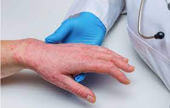 Đậu mùa khỉ có thể tự khỏi và phòng ngừa bằng vaccine