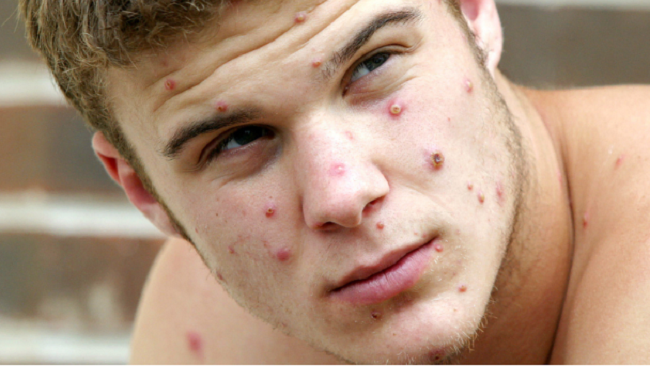 Cùng nhau chống lại dịch đậu mùa khỉ