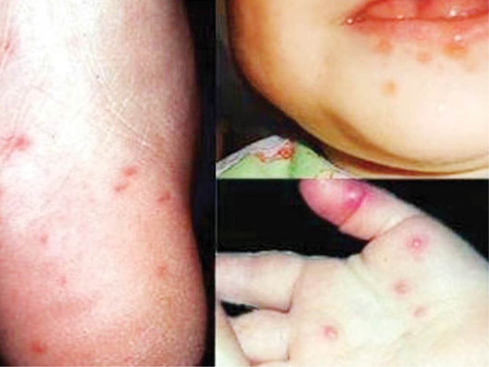 Chú ý dịch bệnh tay chân miệng