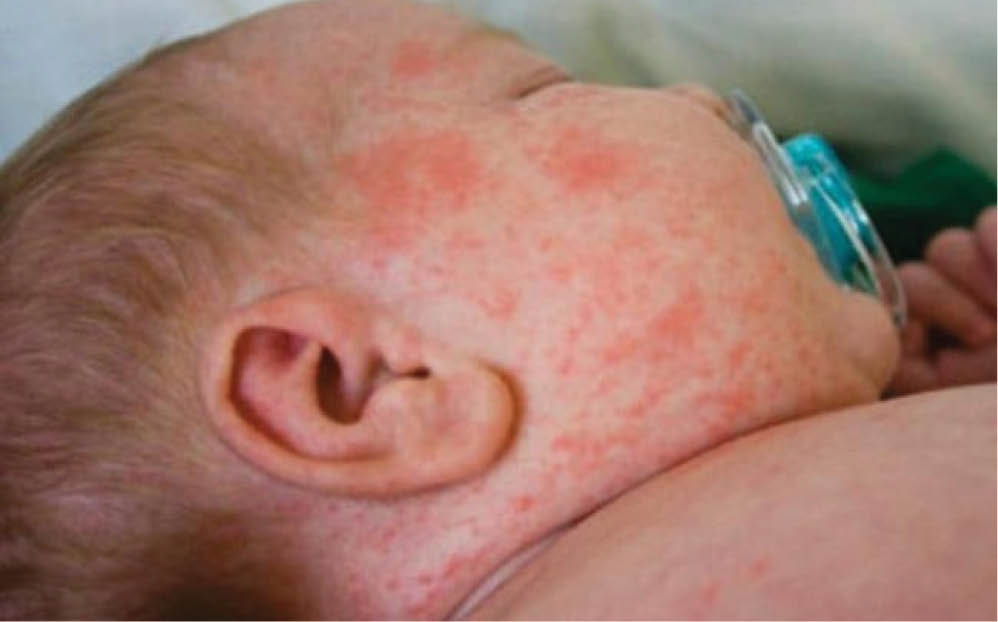 Sốt xuất huyết - những dấu hiệu nặng - khi nào cần nhập viện