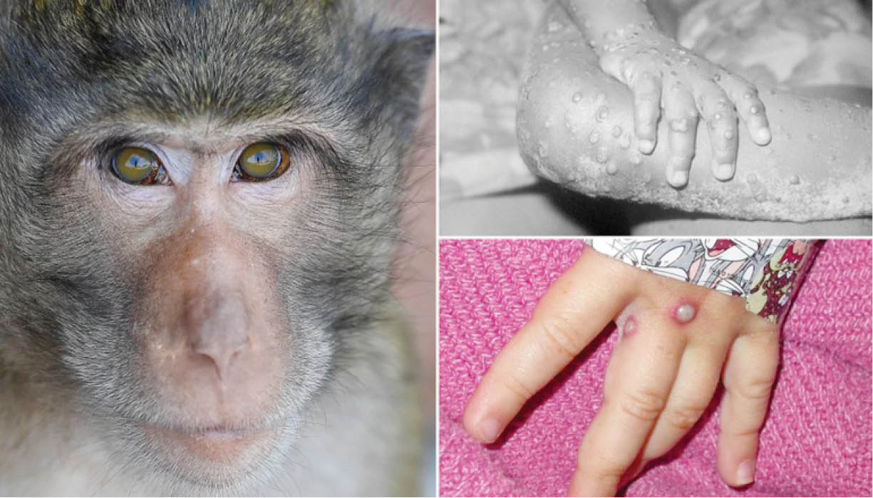 Chủ động kiểm soát khả năng xâm nhập bệnh đậu mùa khỉ