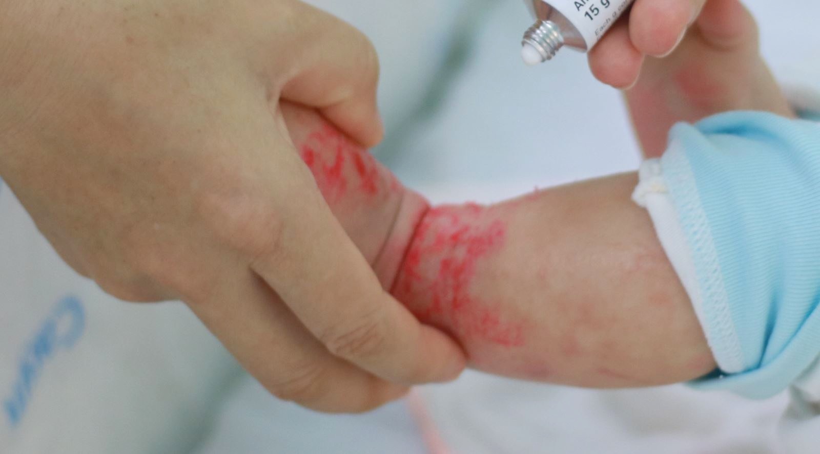 Cập nhật chẩn đoán và điều trị bệnh da ở trẻ sơ sinh