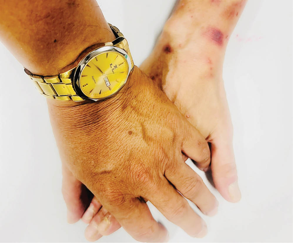 Nguy cơ kép đối với nhóm nam quan hệ tình dục đồng giới