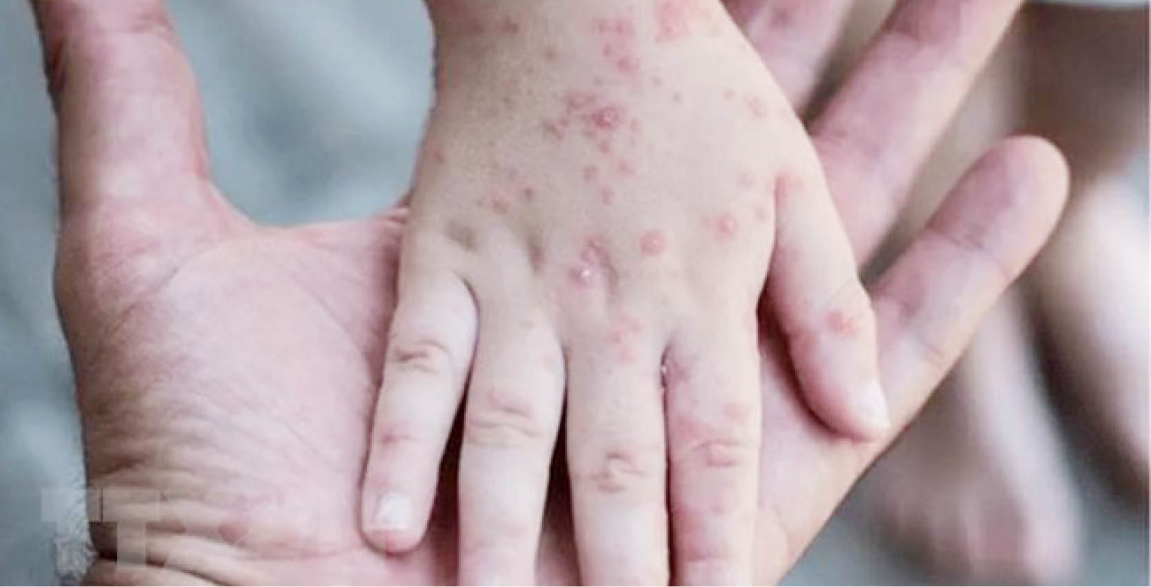 Hàng trăm người châu Âu sang nước khác tiêm vaccine đậu mùa khỉ