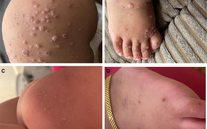 Cúm cà chua – Căn bệnh mới ở trẻ em gây nhiều lo lắng